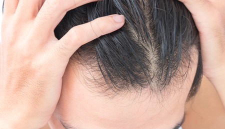 Young man serious hair loss problem for health care shampoo and beauty product conceptの写真素材