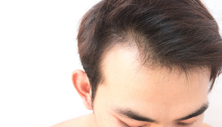 Young man worry hair loss problem for health care shampoo and beauty product conceptの写真素材
