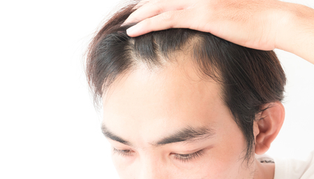 Young man serious hair loss problem for health care shampoo and beauty product conceptの写真素材