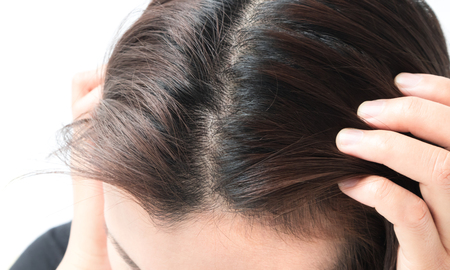 Woman serious hair loss problem for health care shampoo and beauty product conceptの写真素材
