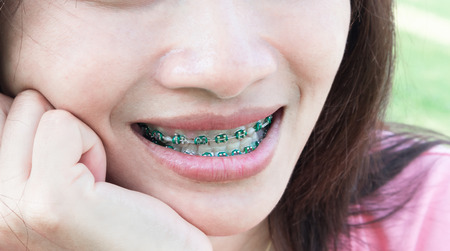 Close up woman smiling with Ceramic and Metal Bracesの写真素材