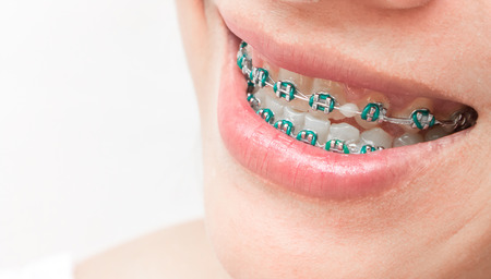 Close up woman smiling with Ceramic and Metal Bracesの写真素材