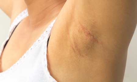 Women problem black armpit on white background for skin care and beauty conceptの写真素材