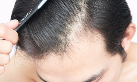Young man serious hair loss problem for health care shampoo and beauty product conceptの写真素材