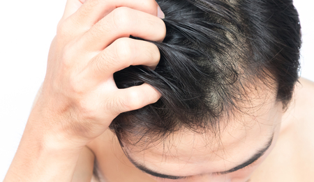 Closeup man hand itchy scalp, Hair care conceptの写真素材