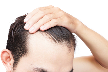 Young man serious hair loss problem for health care shampoo and beauty product conceptの写真素材