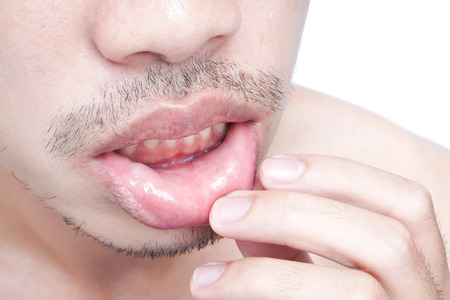 Closeup of lips man problem health care, Herpes simplexの写真素材