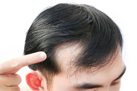 Young man serious hair loss problem for health care medical and shampoo product concept