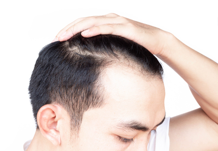 Young man serious hair loss problem for health care medical and shampoo product conceptの写真素材