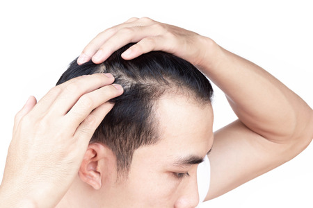 Young man serious hair loss problem for health care medical and shampoo product conceptの写真素材