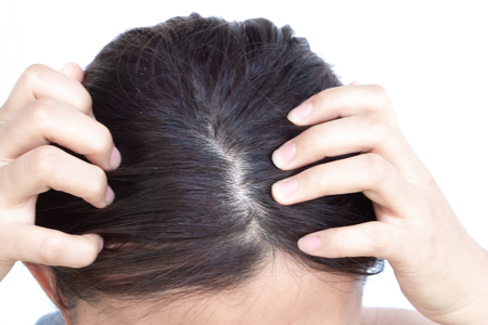 Closeup woman hand itchy scalp, Hair care conceptの写真素材