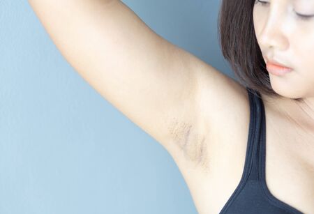 Women problem black armpit lying on white bed background for skin care and beauty concept, selective focusの写真素材