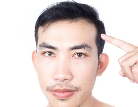 Young man serious hair loss problem for health care medical and shampoo product concept, selective focusの写真素材