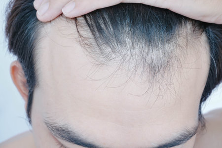 Young man serious hair loss problem for health care medical and shampoo product concept, selective...