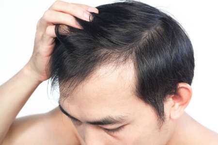 Closeup Young man serious hair loss problem with white backgroun for health care medical and shampoo...