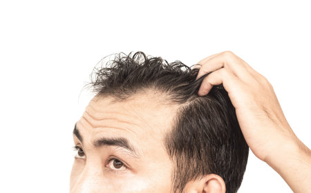 Closeup Young man serious hair loss problem with white backgroun for health care medical and shampoo...