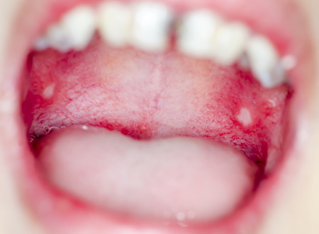 infection of ulcer inside mouth - Macro close up and depth of field (DOF) effect in open mouthの写真素材