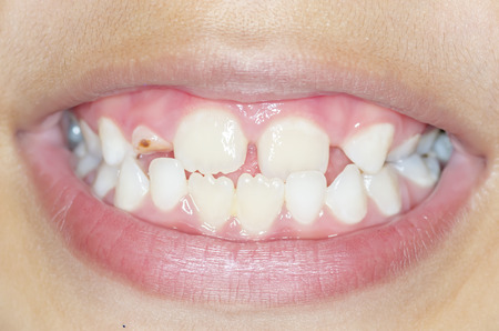 Asian boy smile with decayed teeth