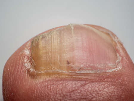 Nail infections caused by fungi such as: onychomycosis also known as tinea unguium. Caused by dermatophytes and yeasts and for the concomitant antibacterial activityの写真素材