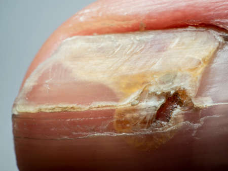 Nail infections caused by fungi such as: onychomycosis also known as tinea unguium. Thumb infection....