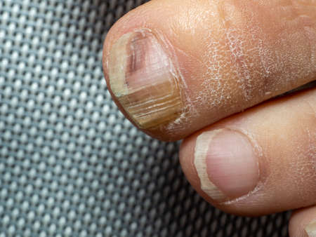Nail infections caused by fungi such as: onychomycosis also known as tinea unguium. Caused by dermatophytes and yeasts and for the concomitant antibacterial activityの写真素材