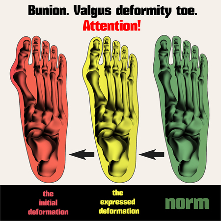 Bunion. Valgus deformity toe.のイラスト素材