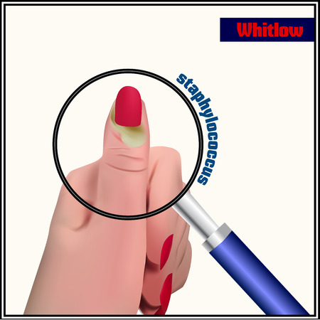 Whitlow. An abscess in the soft tissue near a fingernail.のイラスト素材