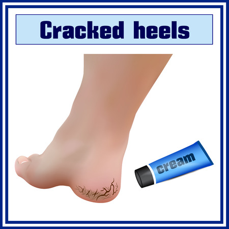 Cracked heels. Foot diseases.のイラスト素材