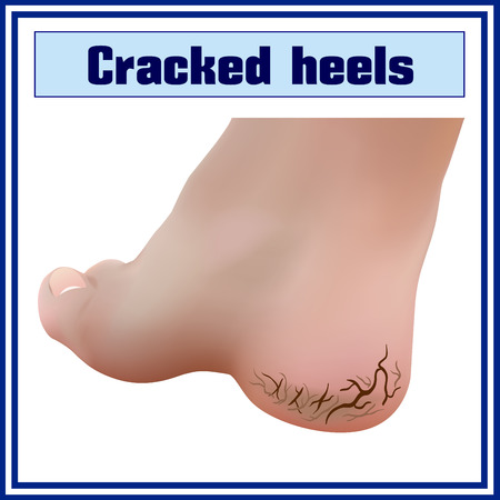 Cracked heels. Foot diseases.のイラスト素材