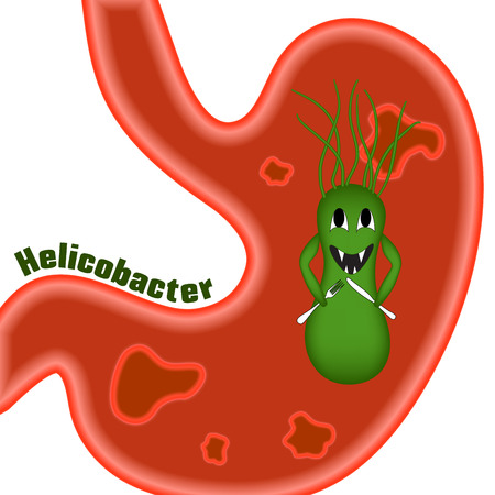 Helicobacter pylori. Ulcers. The disease of the stomach and duodenum. ?aricature, cartoon.のイラスト素材