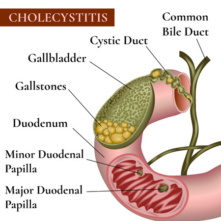 ?holecystitis. Inflammation of the gallbladder and bile ducts. Gallstones.Cholelithiasis. Calculous cholecystitis.のイラスト素材