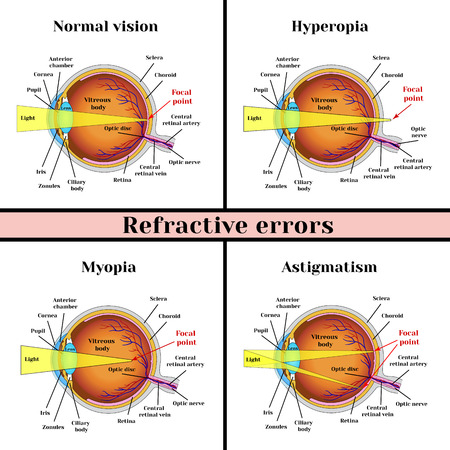 Refractive errors eyeball: hyperopia, myopia, astigmatism.のイラスト素材