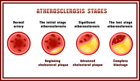 Atherosclerosis stages. Disturbance of lipid and protein metabolism, adjournment the cholesterol...