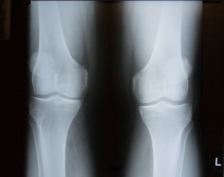X-Ray Image of Knees.  Both Left and Right Legs are included.の写真素材