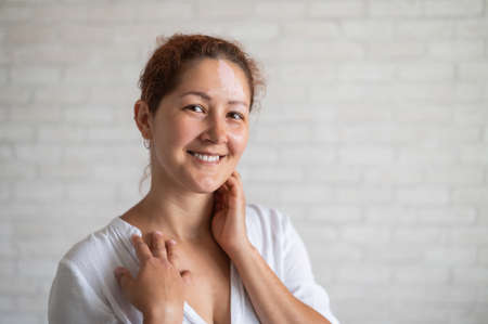 Vitiligo. Portrait of a beautiful smiling woman with lack of skin pigmentation on her forehead. A girl with a white spot on her face. Autoimmune disease.の写真素材