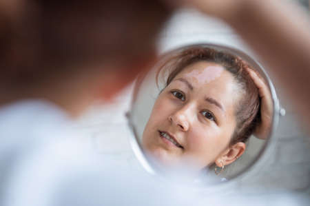 A woman with vitiligo looks in the mirror. Reflection in a table mirror a girl with a white spot on her forehead. Autoimmune disease. Lack of skin pigmentation.の写真素材