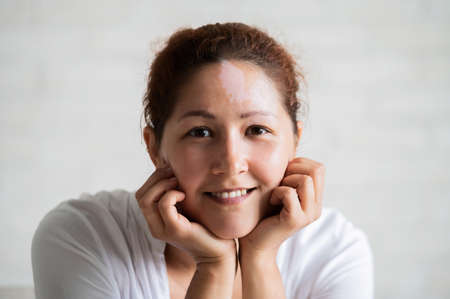 Portrait of a smiling woman with Vitiligo Disease.の写真素材