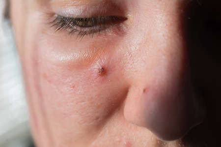Acne on a womans face close up. Portrait of a woman with problem skin