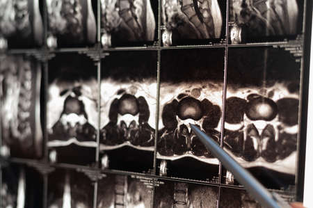 Doctor points on magnetic resonance imaging of the lumbar spine