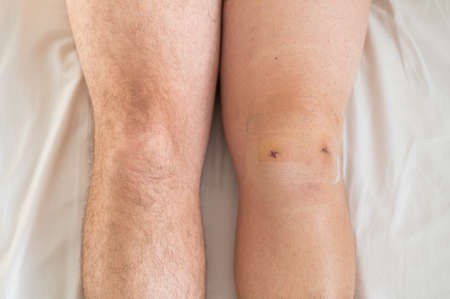 Close-up of a surgical suture after laparoscopic minisk surgery. A man with one knee operated onの写真素材