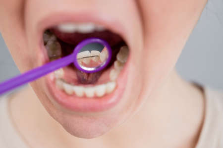 Close-up portrait of a woman with internal braces and a dental mirror. The girl corrects the biteの写真素材