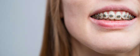 Close-up of a young womans smile with metal braces on her teeth. Correction of biteの写真素材