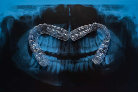 Transparent bite correction trays and x-ray of the jaw. Orthodontist equipmentの写真素材