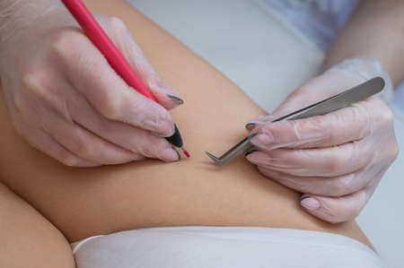 The doctor does electro epilation of the bikini zone to a woman in the salon. An alternative way to...