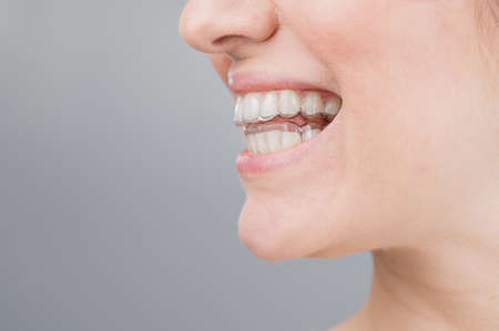 Close-up portrait of a woman with a plastic transparent retainer. A girl corrects a bite with the help of an orthodontic device. Copy spaceの写真素材