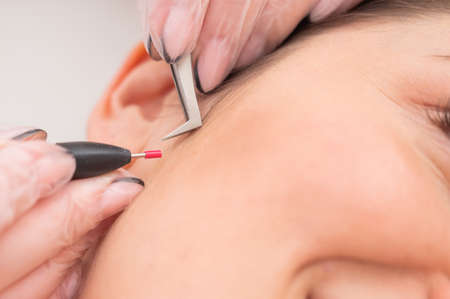 Woman on electro-epilation of the face. Hardware permanent removal of unwanted hair in the salonの写真素材