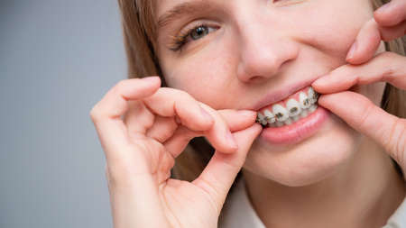 Close-up portrait of a red-haired girl touching braces. Young woman corrects bite with orthodontic appliance.の写真素材
