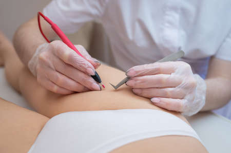 The doctor does electro epilation of the bikini zone to a woman in the salon. An alternative way to permanently remove unwanted body hairの写真素材