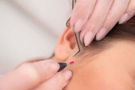 Woman on electro-epilation of the face. Hardware permanent removal of unwanted hair in the salon