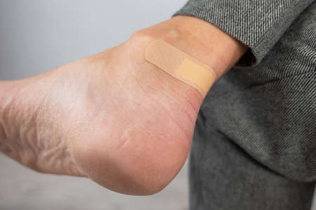 A woman seals a corn on her leg with a plaster. The girl rubbed her leg with uncomfortable shoes.の写真素材